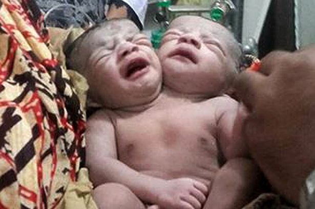 A Bangladeshi baby girl born with two heads - В Республике Бангладеш родилась девочка с двумя головами